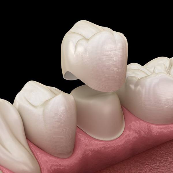 Exploded illustration of dental crown and treated tooth