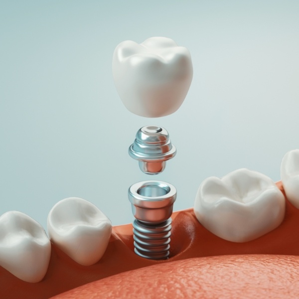 Animated dental implant supported dental crown