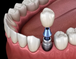 Animated dental implant supported dental crown placement