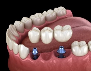 Animated dental implant supported fixed bridge placement