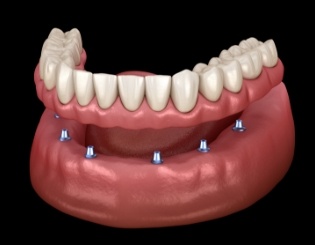 Animated dental implant supported denture placement