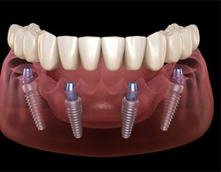 Lower implant-supported denture