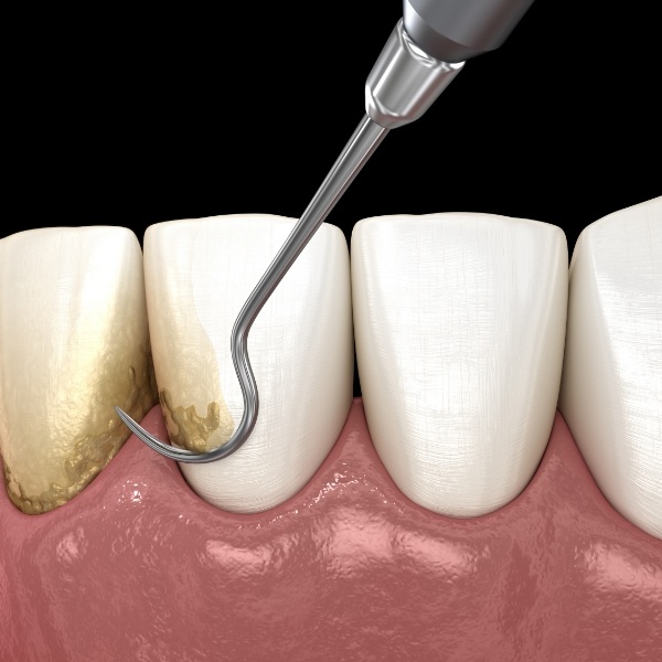 Animated smile during scaling and root planing periodontal treatment