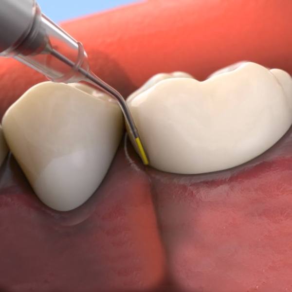 Animated smile during Arestin Antibiotic therapy