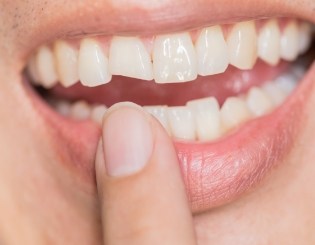Smile with chipped front tooth