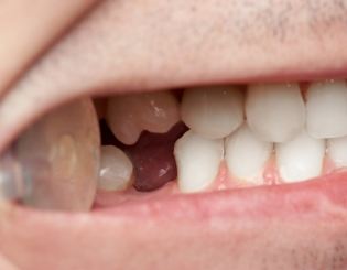 Smile with knocked out tooth