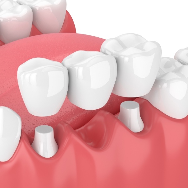 Animated smile with dental bridge replacing missing teeth