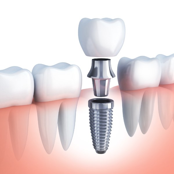 Animated smile during dental implant supported dental crown placement