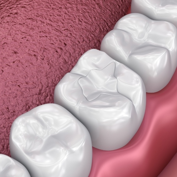 Animated smile with tooth colored filling restorative dentistry treatment