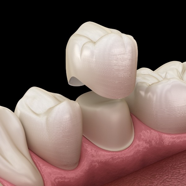 Animated smile during metal free dental crown cosmetic dentistry treatment