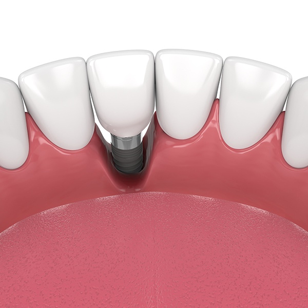 Illustration of bone loss around a failed dental implant in Pinehurst, NC