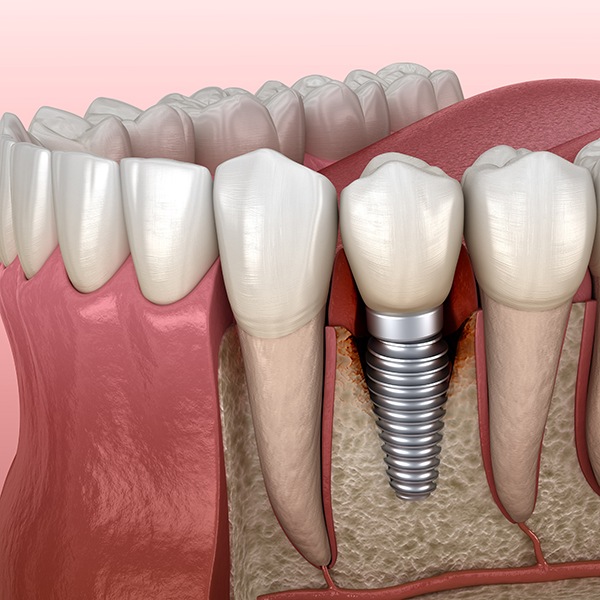 Illustration of bone loss around dental implant