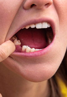 Woman missing a tooth