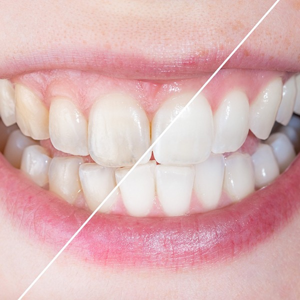 Before and after image of stained and whiter teeth