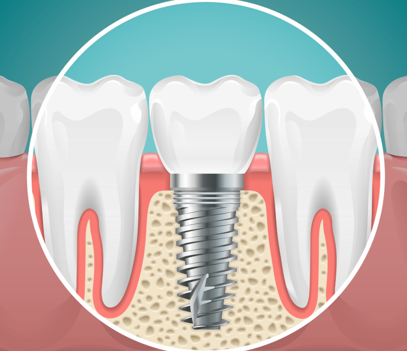 Illustrated cross section of a dental implant